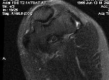 Elbow MRI Lateral Epicondylitis